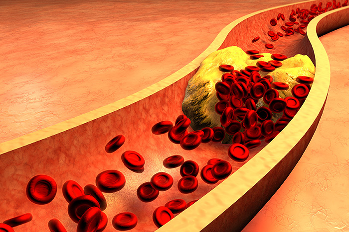 5 Effective Tips to Reduce High Cholesterol